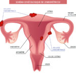ENDOMETRIOSE